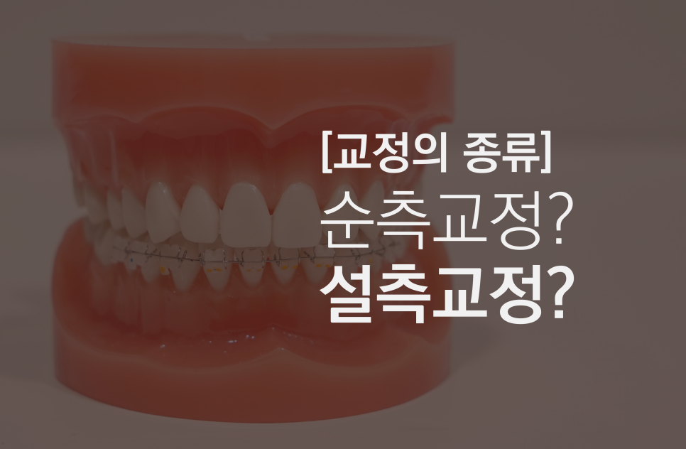 2D(투디)치과!치아교정!클리피씨교정,순측 교정?설측교정? 관련 이미지 1