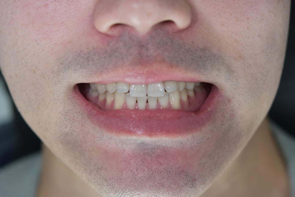 라미네이트치과 알아본다면? 관련 이미지 8