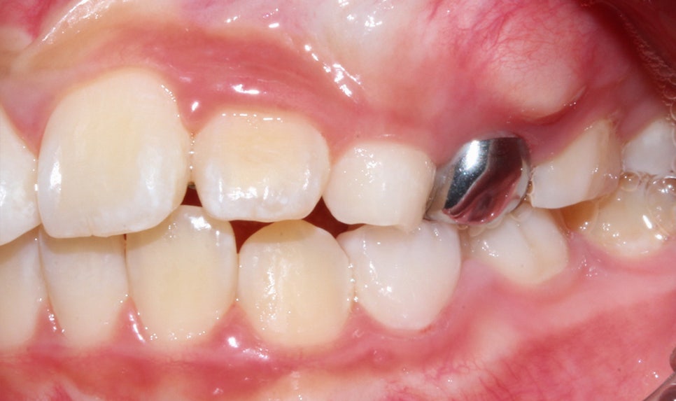 어린이 반대교합 덧니 교정으로 교정 끝! by. 투디치과(2D치과) 관련 이미지 5