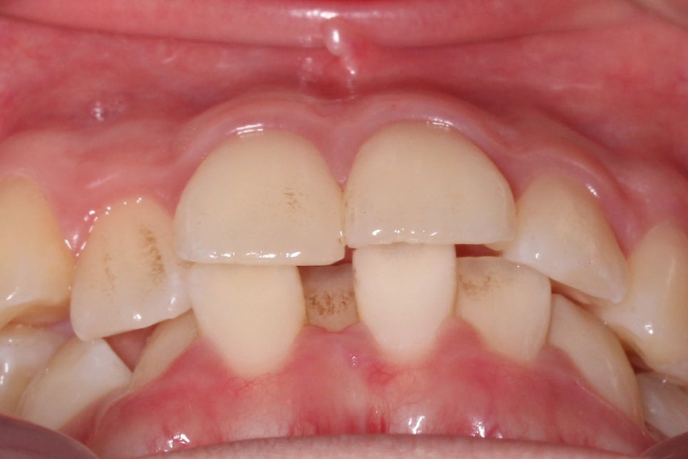 투디치과 송곳니덧니 치료 후기 관련 이미지 2