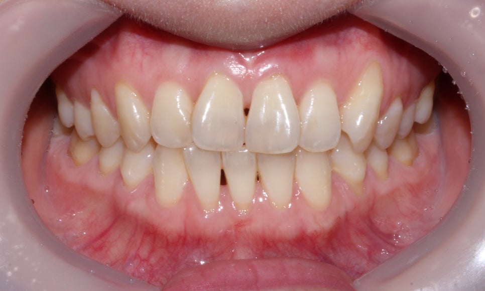 나비치아 교정 케이스 전후비교, 교정전문 2D치과 관련 이미지 7