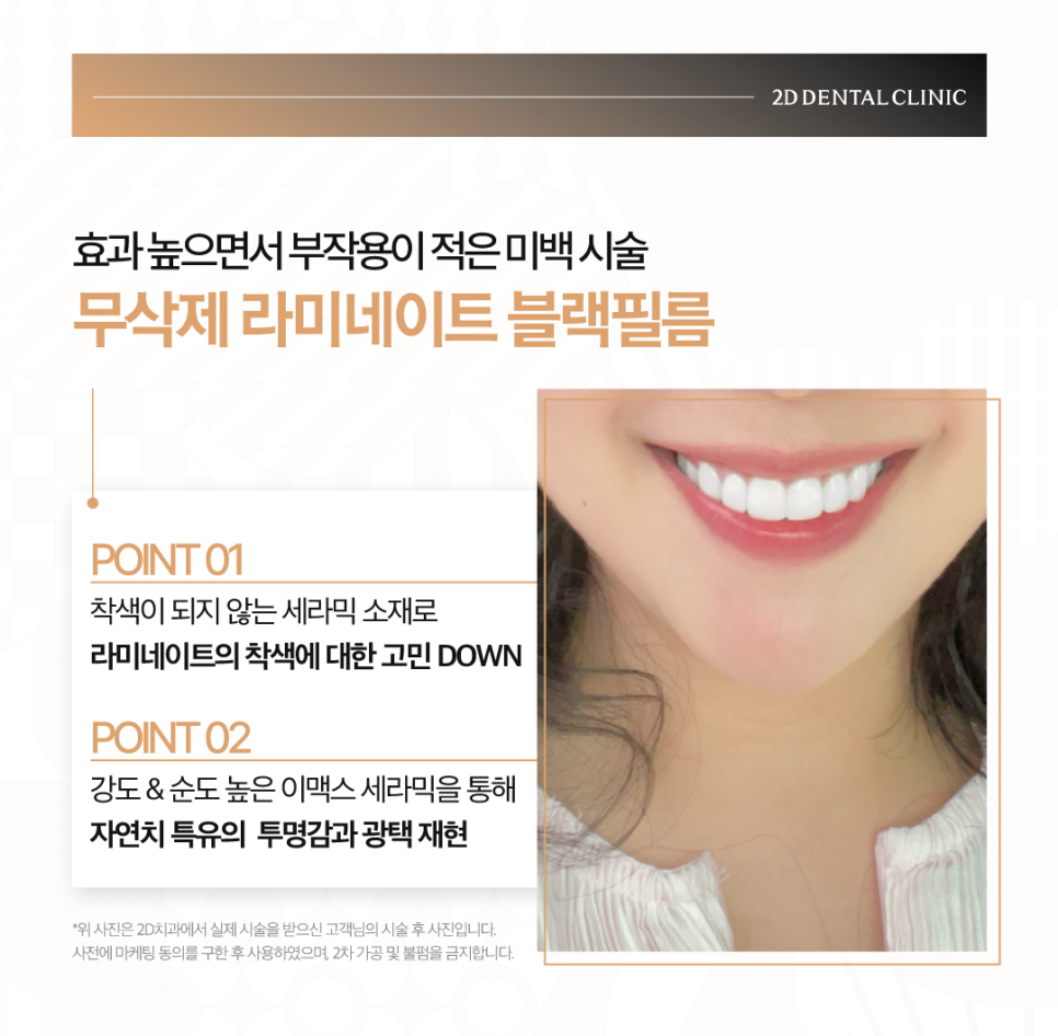 창원무삭제라미네이트 치과치아미백 어떤 방법이 좋을지 고민될 때 관련 이미지 4