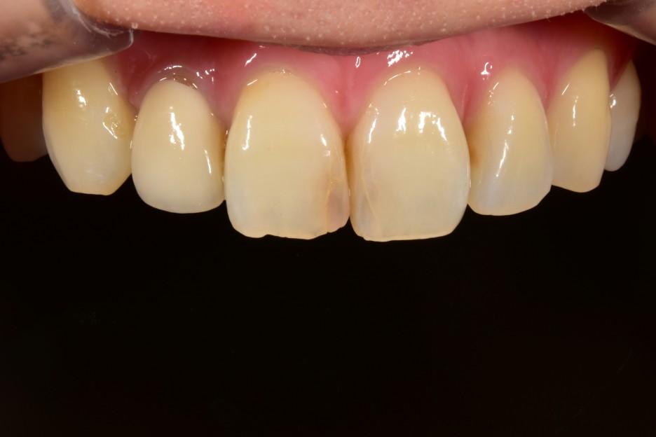 [투디치과] 블랙필름(비스포크) 치료의 다양한 사례 관련 이미지 29