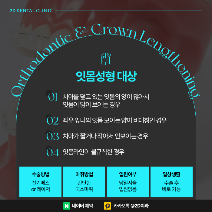 거미스마일 개선을 위한 치아교정, 강남 잇몸성형 관련 이미지 4