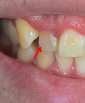 치아성형 잇몸성형 치아삭제 없는 무삭제라미네이트 블랙필름 관련 이미지 8