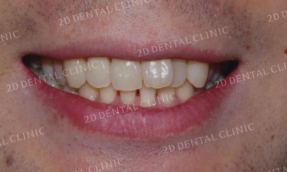 [투디교정] 부정교합 앞니교정을 투디교정으로 고르게! by.투디치과(2D치과) 관련 이미지 9