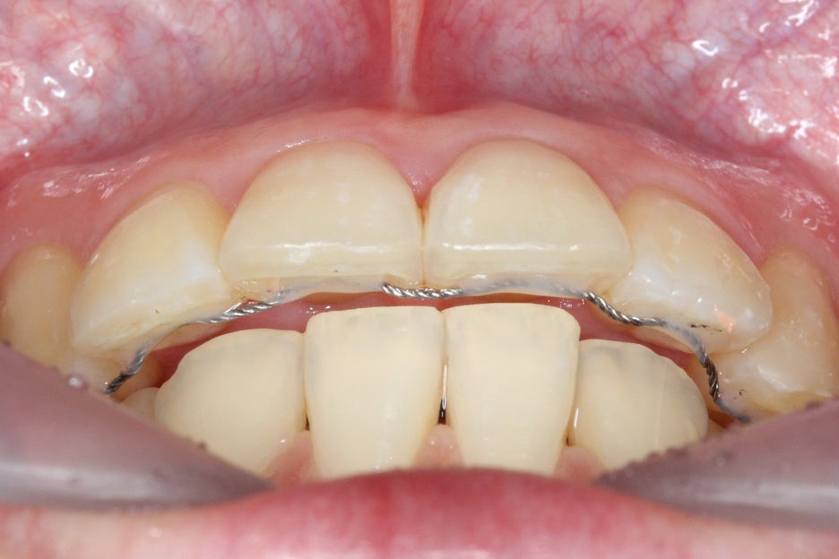 토끼앞니교정 부분교정으로 단기완성 관련 이미지 9