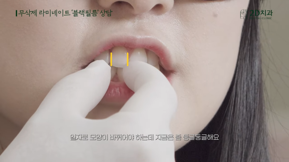 [블랙필름 상담받고 왔어요] #1 큰 앞니 작게 만들 수 있나요? 관련 이미지 10