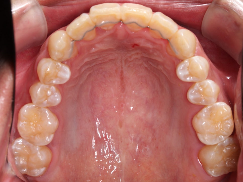 앞니 덧니 고민, 부분 설측 교정으로 해결한 사례 관련 이미지 16