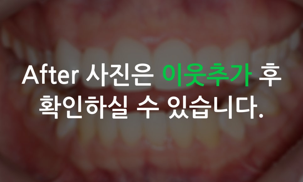 송곳니덧니 교정과 왜소치 세라필름을 한번에! 관련 이미지 7