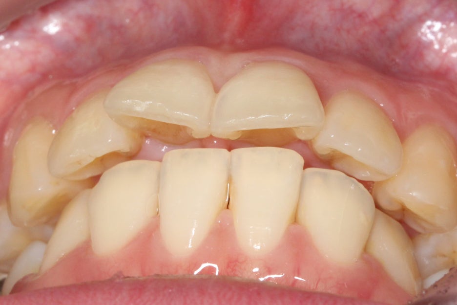 토끼앞니교정 부분교정으로 단기완성 관련 이미지 3