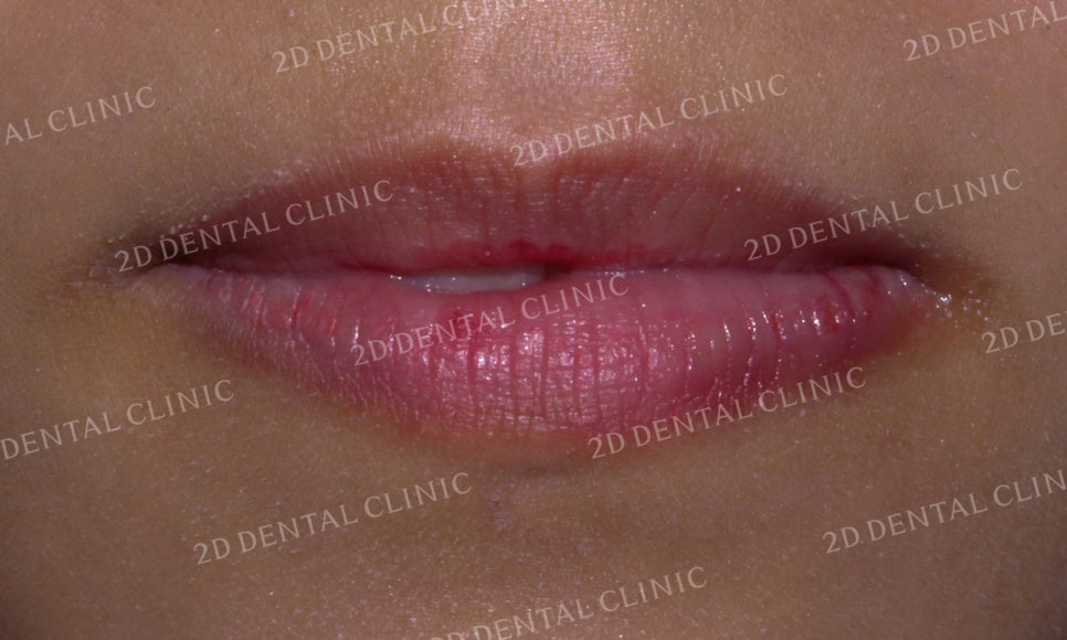 토끼앞니, 튀어나온 앞니 부분교정 후기! by.투디치과(2D치과) 관련 이미지 2