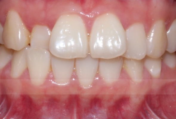 치료목적으로 진행되는 치아교정과 무삭제라미네이트 관련 이미지 3