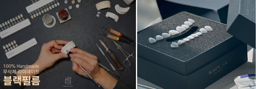 치아라미네이트 잘 하는 투디치과 관련 이미지 14