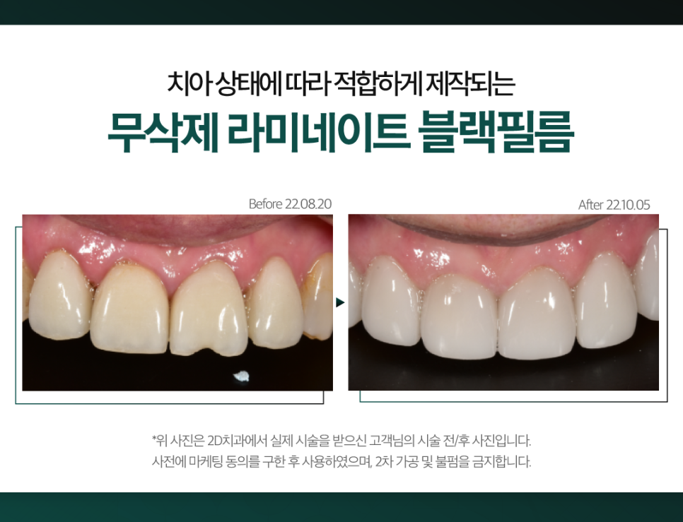 무삭제라미네이트가격 앞니파절 딱딱한 음식 먹다가 이가 부러졌다면 관련 이미지 6