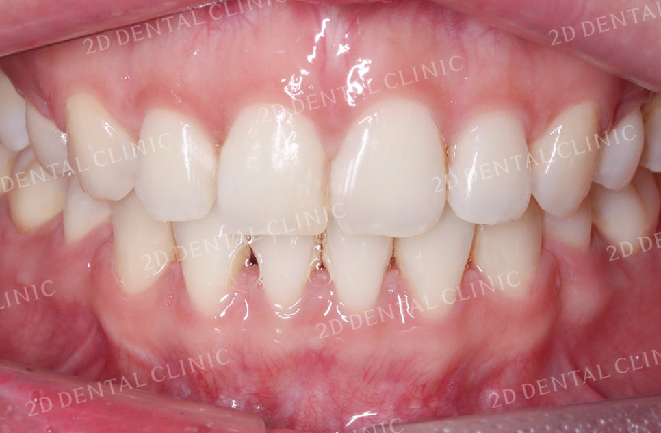 비대칭 앞니, 돌출앞니를 전체 교정으로 교정하고 싶다면!? by.투디치과(2D치과) 관련 이미지 10