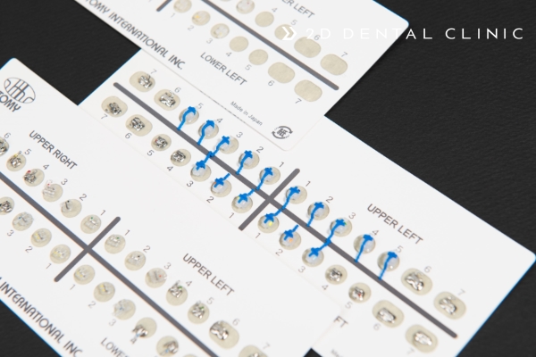 2D교정? 클리피씨? 자가결찰 브라켓! 강남 투디치과 관련 이미지 1