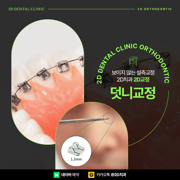 덧니부분교정 2D교정으로 해결, 강남 설측교정 관련 이미지 1