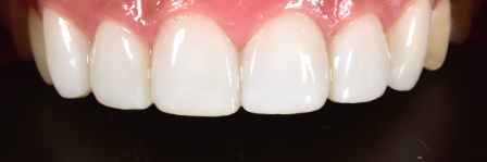 거미스마일 잇몸성형 강남라미네이트 2D치과 관련 이미지 2