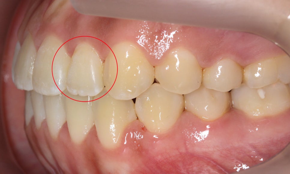 톱니모양 치아를 매끄러운 치아모양으로 개선하는 방법! (마멜론치아) 관련 이미지 8