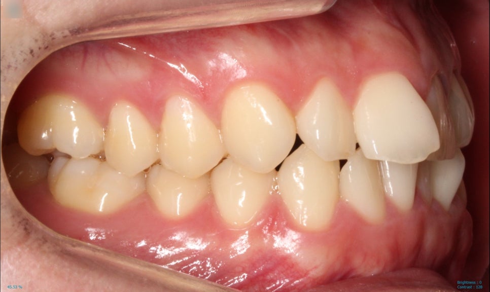 부분교정으로 삐뚤어진 앞니 예뻐지는 방법 관련 이미지 9