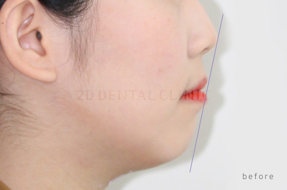 [돌출입 무턱] 안모교정 진행중! by.투디치과(투디치과)전체교정 관련 이미지 9