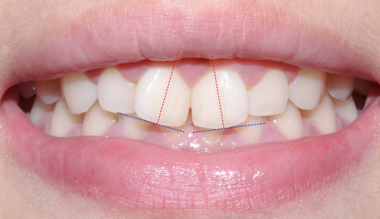 옥니 라미네이트 치아고민은 그만 치아삭제 없는 블랙필름으로 해결 관련 이미지 2