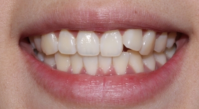 부분교정으로 5개월만에 예뻐졌어요*^_^* 관련 이미지 1