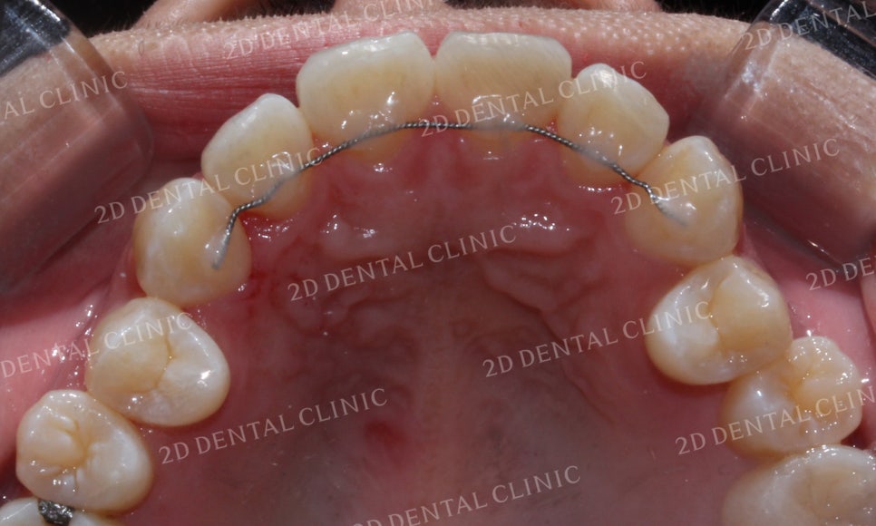토끼앞니, 튀어나온 앞니 부분교정 후기! by.투디치과(2D치과) 관련 이미지 15