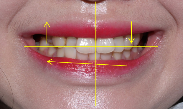 덧니 투명교정 8개월 치료 사례 관련 이미지 4