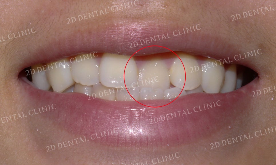 반대교합 치아교정, 앞니를 가지런하게! by.투디치과(2D치과) 관련 이미지 3