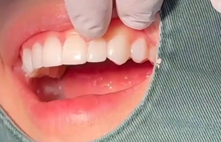 무삭제라미네이트 치아삭제없는 0.1mm 얇은 블랙필름 관련 이미지 7