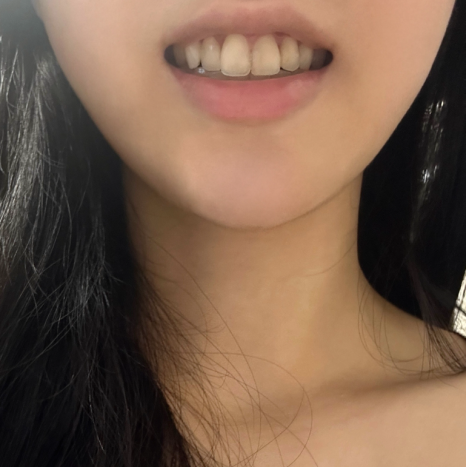 부분 라미네이트 치아 심미치료는 무삭제로 진행가능한 블랙필름 관련 이미지 6