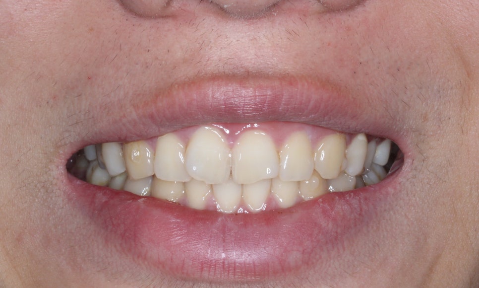 나비치아교정! 15개월만에 빠른 교정 by.투디치과(2D치과) 관련 이미지 3