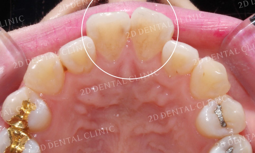 [앞니교정] 부정교합 교정, 앞니교정으로 부정교합 교정하는 방법! by. 투디치과(2D치과) 관련 이미지 6