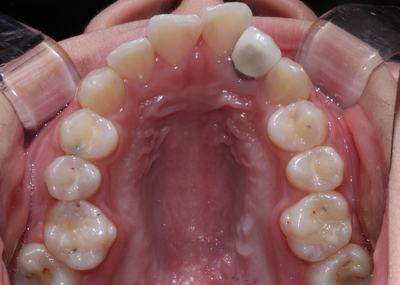 투명교정. 그것이 알고싶다! 관련 이미지 1