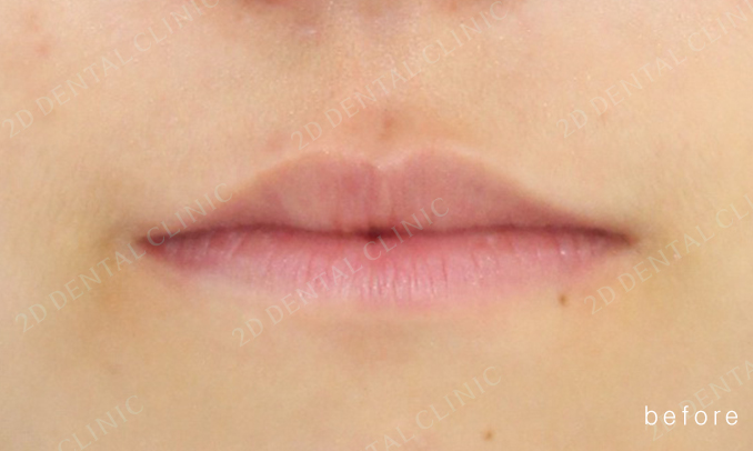 우디의 교정 일기ㅣ부정 교합 치아교정 후기 관련 이미지 10