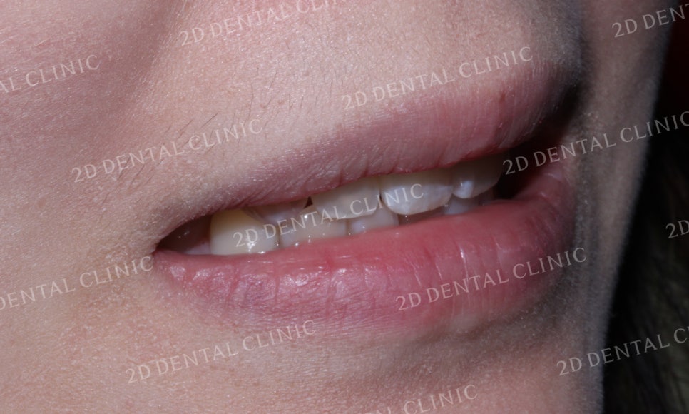 나비치아교정, 부분교정으로 나비치아 탈출하기! by.투디치과(2D치과) 관련 이미지 13