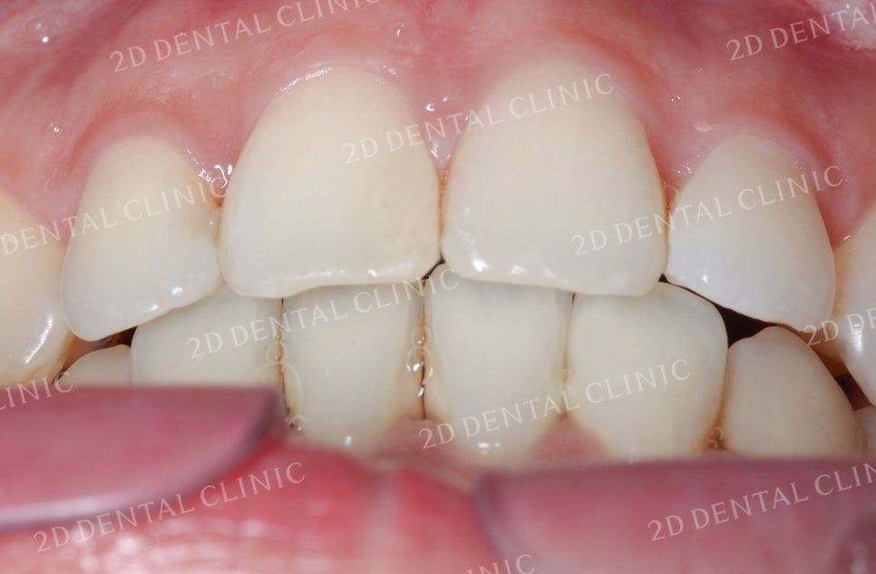 비대칭 앞니, 돌출앞니를 전체 교정으로 교정하고 싶다면!? by.투디치과(2D치과) 관련 이미지 12