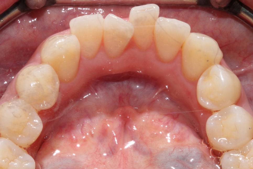 왜소치 뻐드렁니 교정 신논현역치과에서 관련 이미지 7