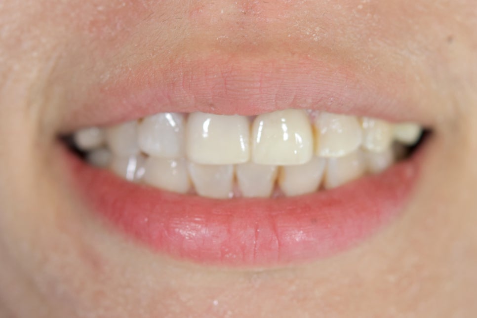 연예인라미네이트 무삭제로 잘하는 2D치과 관련 이미지 6