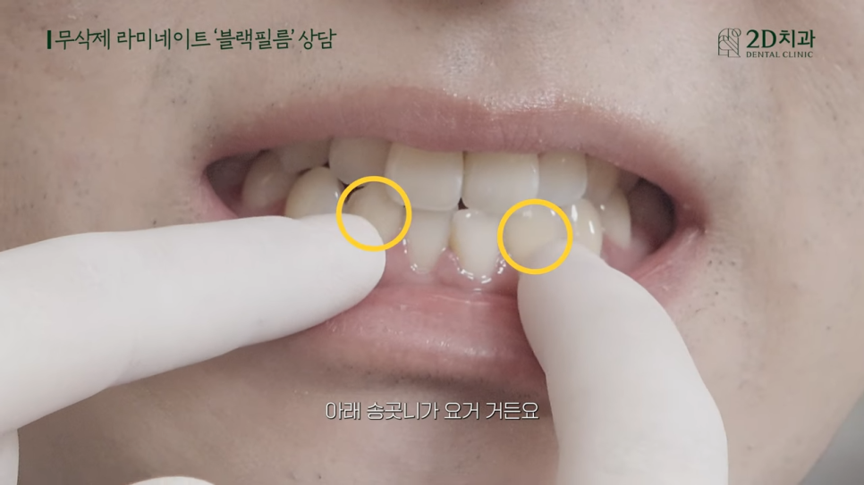 [블랙필름 상담받고 왔어요] #2 반대교합도 가능할까요? 관련 이미지 22