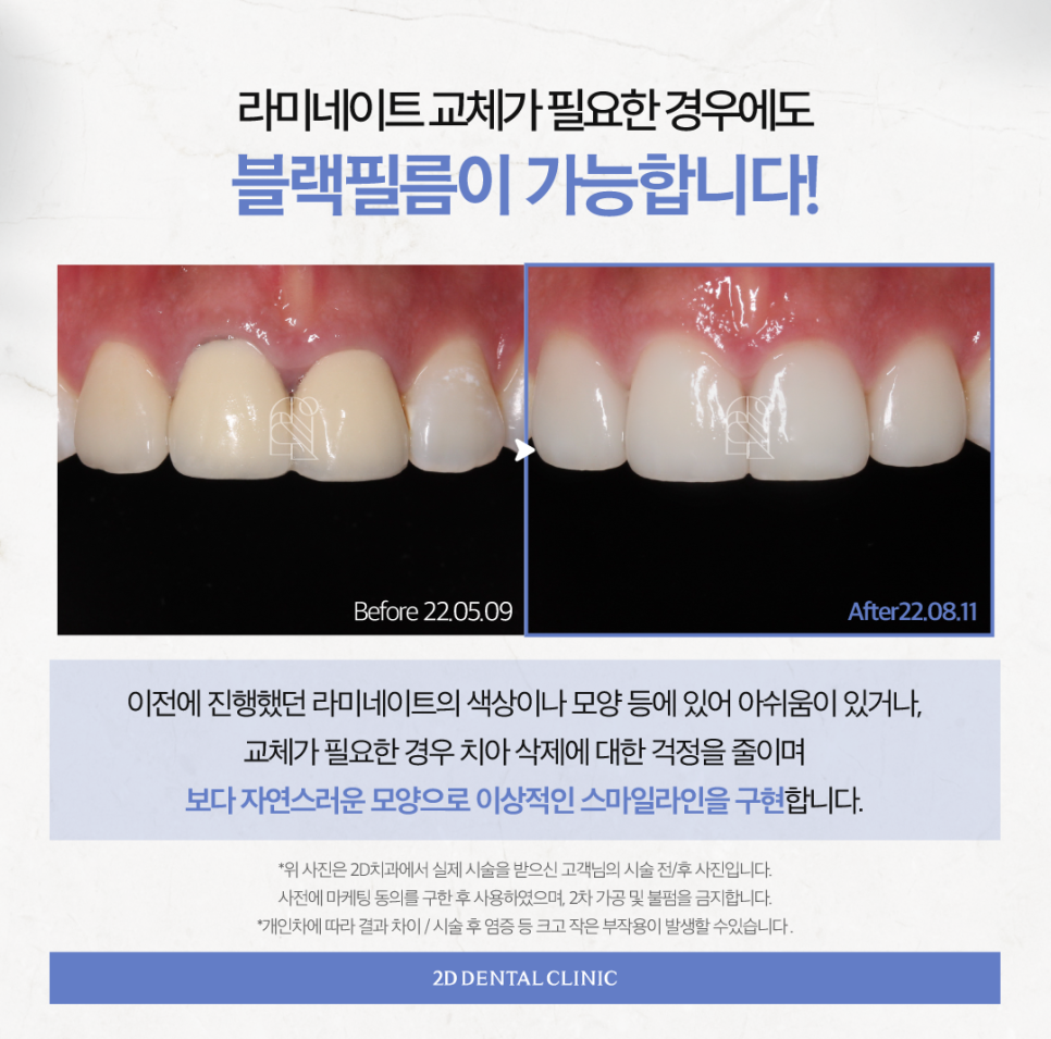 무삭제라미네이트후기 심미보철 나에게 적합한 방식을 찾아보세요 관련 이미지 5