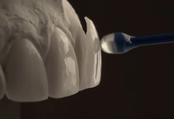 블랙필름 치아 삭제없는 무삭제라미네이트 후기 관련 이미지 9