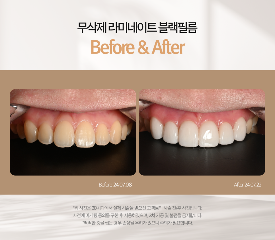 치아화이트닝 하얀이로 거듭날 수 있었던 투디 고객님의 고민은? 관련 이미지 6