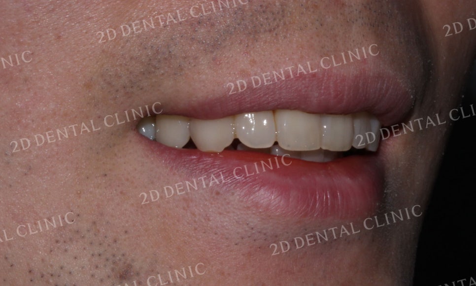 [투디교정] 부정교합 앞니교정을 투디교정으로 고르게! by.투디치과(2D치과) 관련 이미지 12