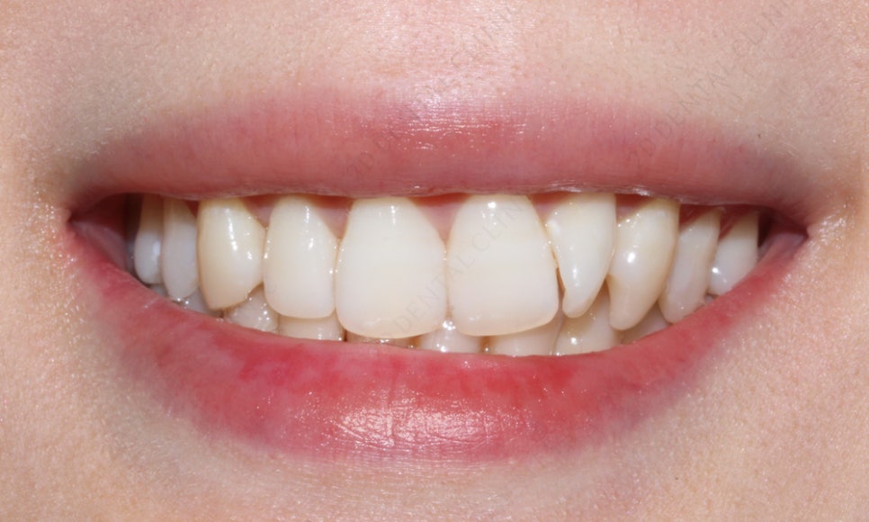 덧니치아 앞니교정 4개월 교정 완료! by. 투디치과(2D치과) 관련 이미지 3