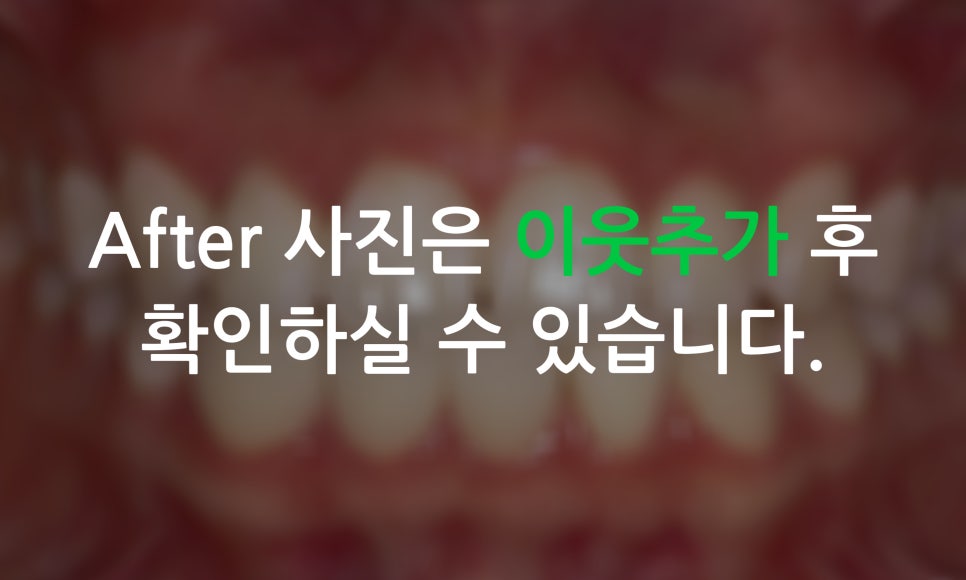나비앞니 교정, 투디교정으로 빠르게 완성하는 방법! 관련 이미지 6