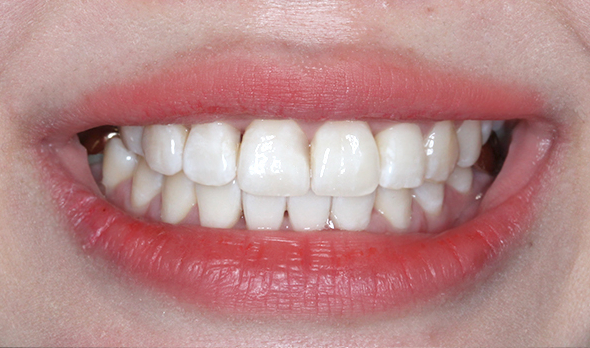 2D치과 2D교정으로 4개월만에 덧니 개선! 관련 이미지 3