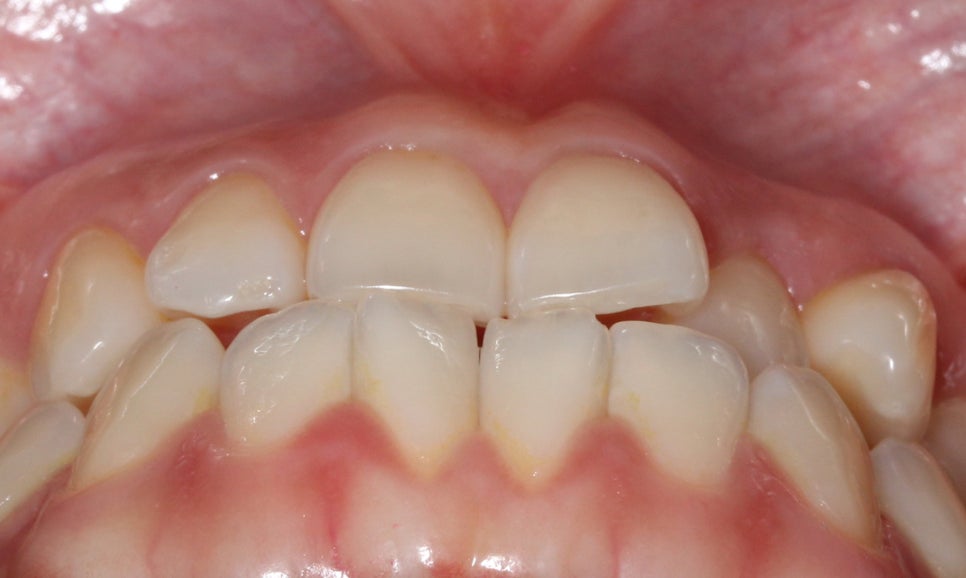 절단교합 클리피씨 교정 방법 관련 이미지 2